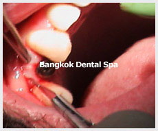 Dental Implants thailand
